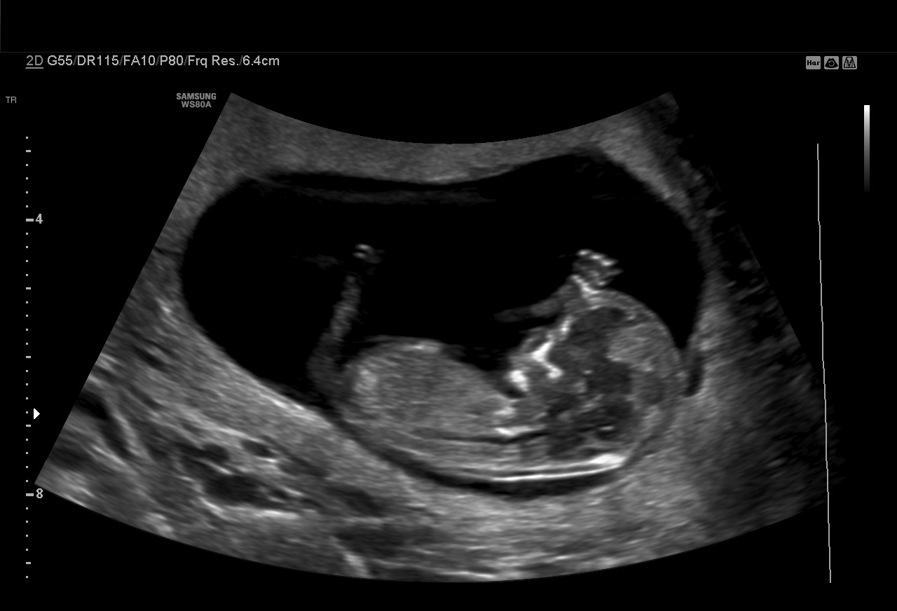 How is a nuchal scan done?