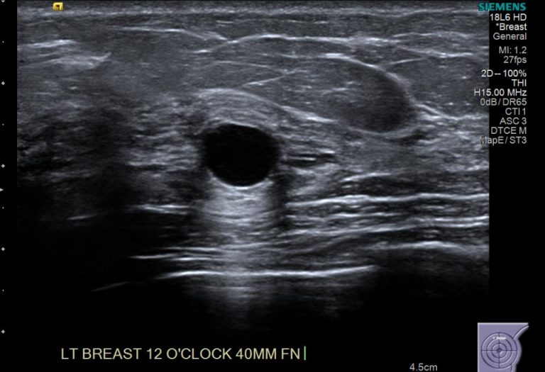lump breast ultrasound