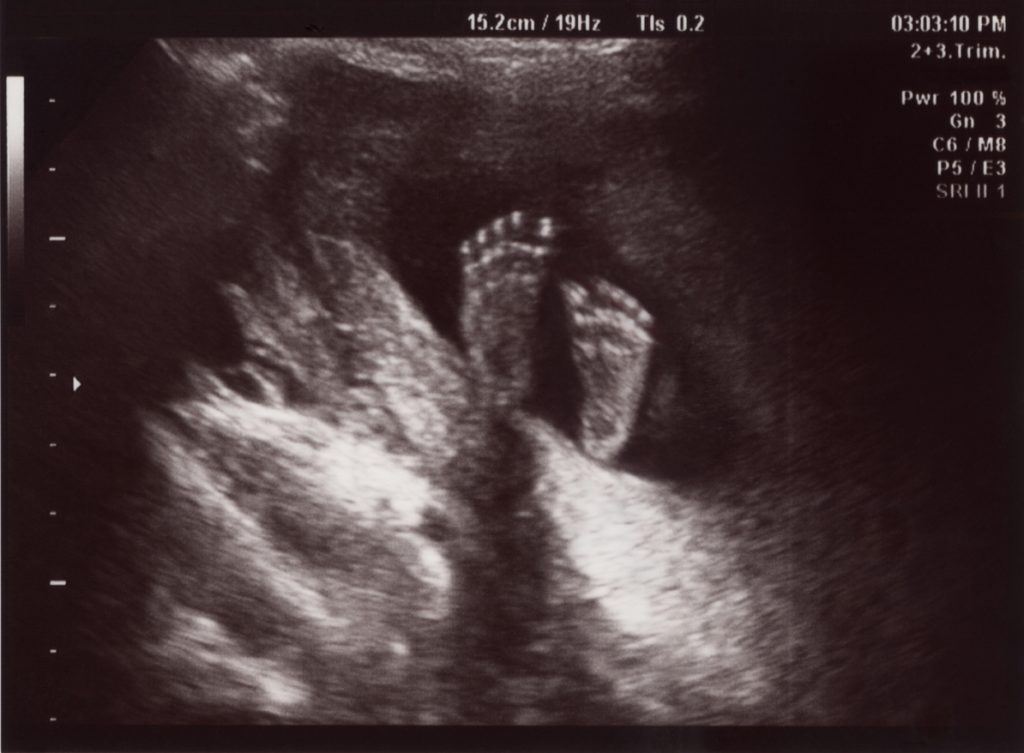 20 Week Scan (Morphology Scan) - Women's Imaging