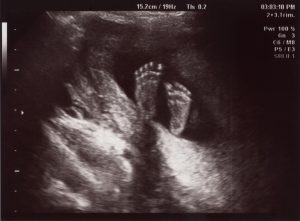 20 Week (Morphology - Women's Imaging