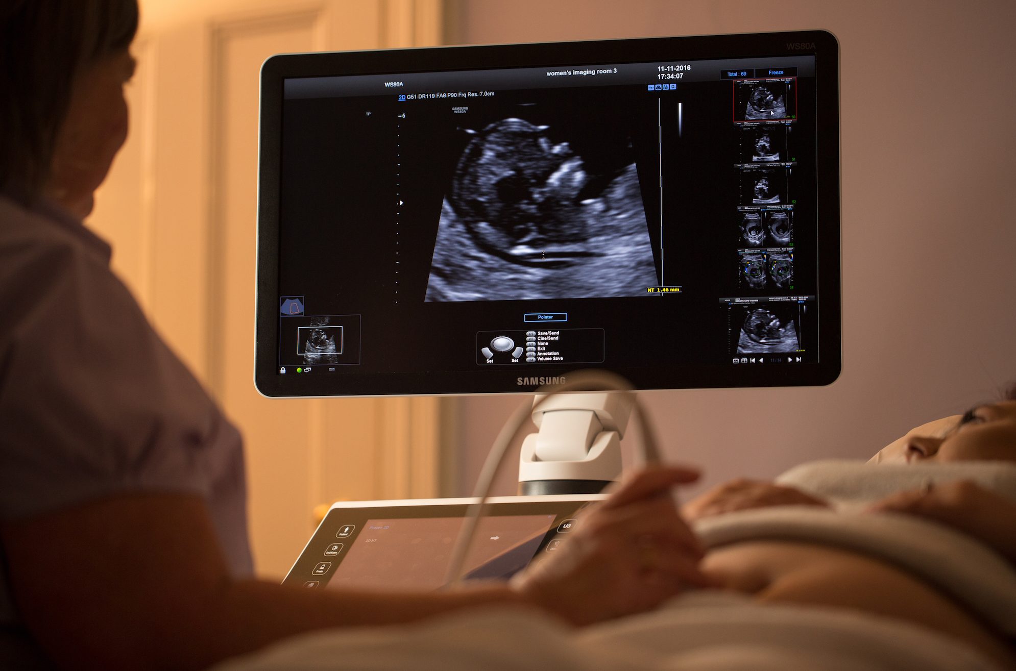 Accuracy Of Dating Scan At 10 Weeks How Accurate Is Conception Date With An Ultrasound At 12 