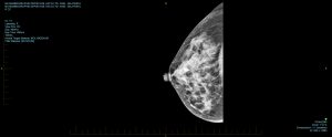 X-ray pictures or images of a woman's healthy breasts with no sign of breast cancer.